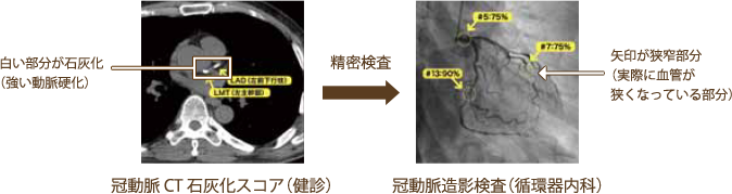 冠動脈CT石灰化スコア