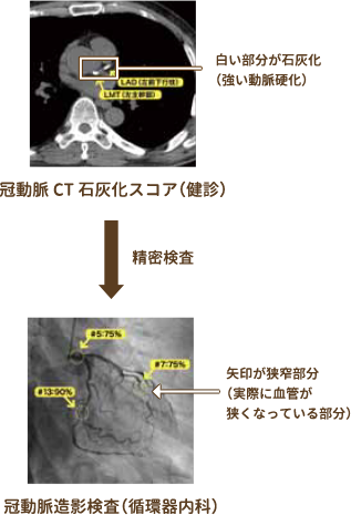 冠動脈CT石灰化スコア